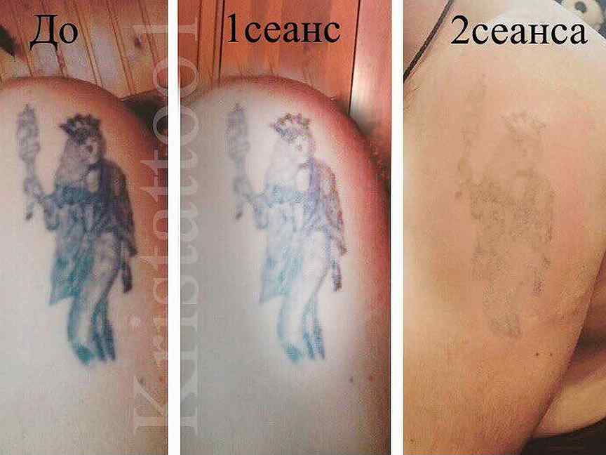 Удаление тату неодимовым. Выведение татуировок лазером. Сведение тату до и после.
